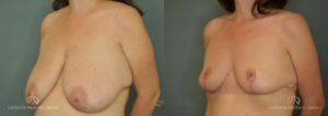 Breast Reduction Before and After Photos Patient 2B