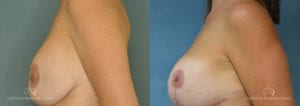 Breast Reduction Before and After Photos Patient 5A