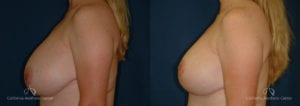 Breast Reduction Before and After Photos Patient 6A