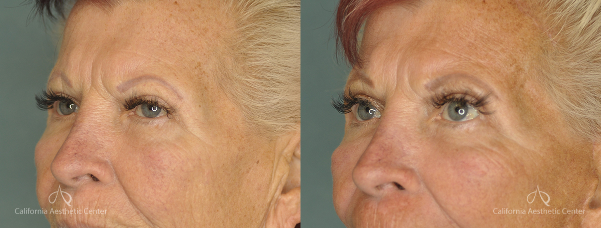 Brow Lift Before and After Photos Patient 1D