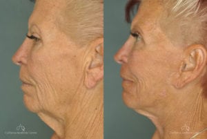 Face Lift Before and After Photos Patient 1C