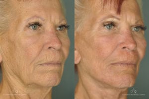 Face Lift Before and After Photos Patient 1D