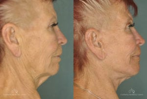 Face Lift Before and After Photos Patient 1E