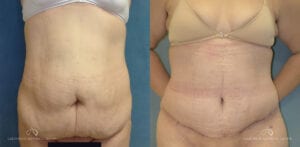 Patient 23 Abdominoplasty Front Before and After