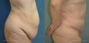 Patient 23 Abdominoplasty Side Before and After