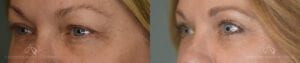 Patient 6 Blepharoplasty Before and After Side 2