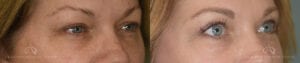 Patient 6 Blepharoplasty Before and After Front Side