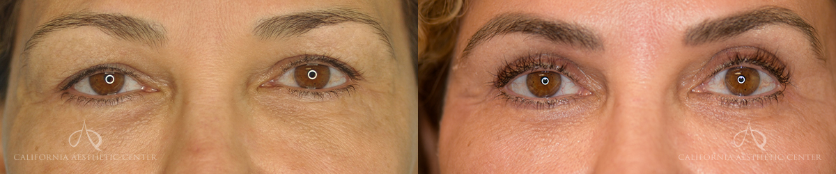 Patient 7 Blepharoplasty Before and After Front