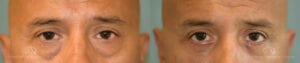 Patient 9 Blepharoplasty Front Before and After