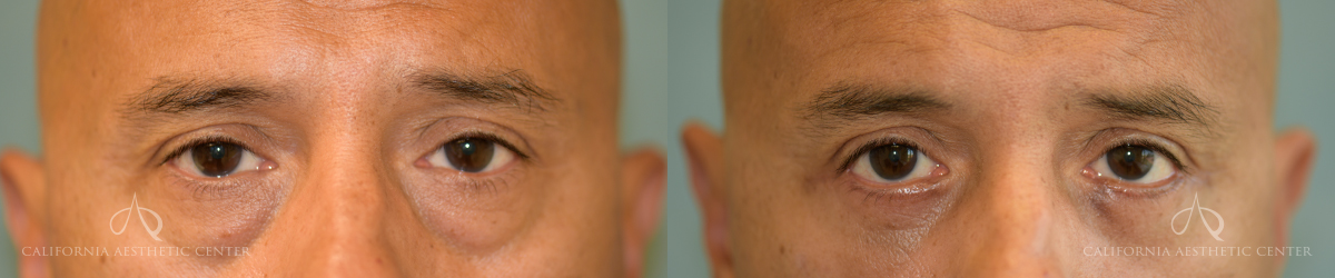 Patient 9 Blepharoplasty Front Before and After