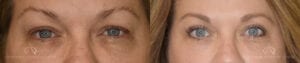 Patient 6 Blepharoplasty Before and After Front