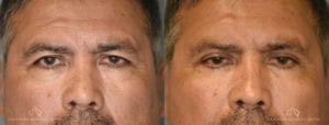 Patient 5 Blepharoplasty Before and After Front View