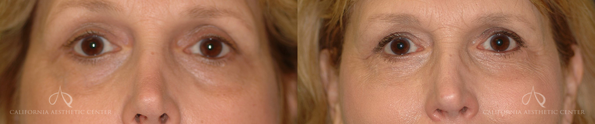 Patient 10 Before and After Blepharoplasty Front View