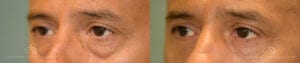 Patient 9 Blepharoplasty Oblique Before and After