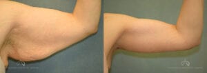 Patient 2 Brachioplasty Before and After Left