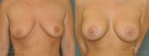 Patient 9 Breast Augmentation Before and After Front View