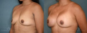 Patient 10 Breast Augmentation Before and After Left Oblique View