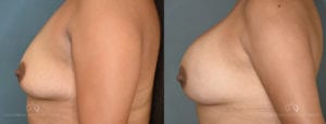 Patient 10 Breast Augmentation Before and After Left Side View