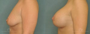 Patient 9 Breast Augmentation Before and After Left Side View