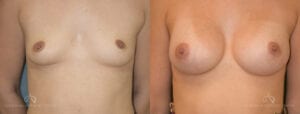 Patient 14 Breast Augmentation Before and After Front