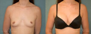 Patient 14 Breast Augmentation Before and After Front 2