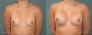 Patient 15 Breast Augmentation Before and After Front