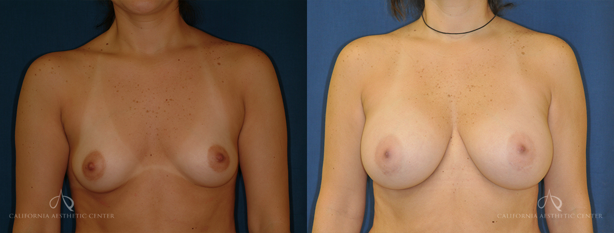 Patient 20 Breast Augmentation Front Before and After