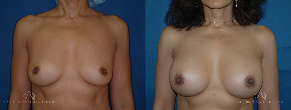 Patient 21 Breast Augmentation Front Before and After