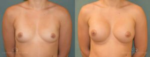 Patient 23 Breast Augmentation Front Before and After