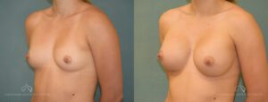 Patient 23 Breast Augmentation Oblique Before and After