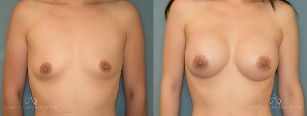 Patient 24 Breast Augmentation Front Before and After