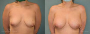 Patient 25 - Breast Augmentation Front Before and After