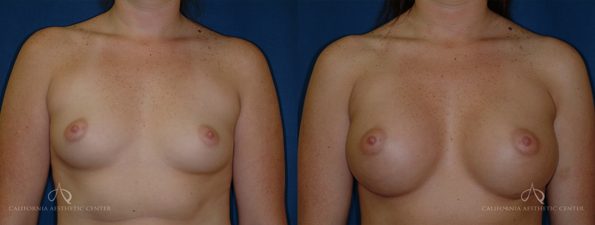 Patient 26 - Breast Augmentation Before and After