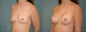 Patient 14 Breast Augmentation Before and After Oblique