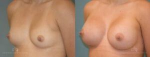 Patient 15 Breast Augmentation Before and After Oblique
