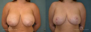 Patient 11 Breast Reduction Front Before and After