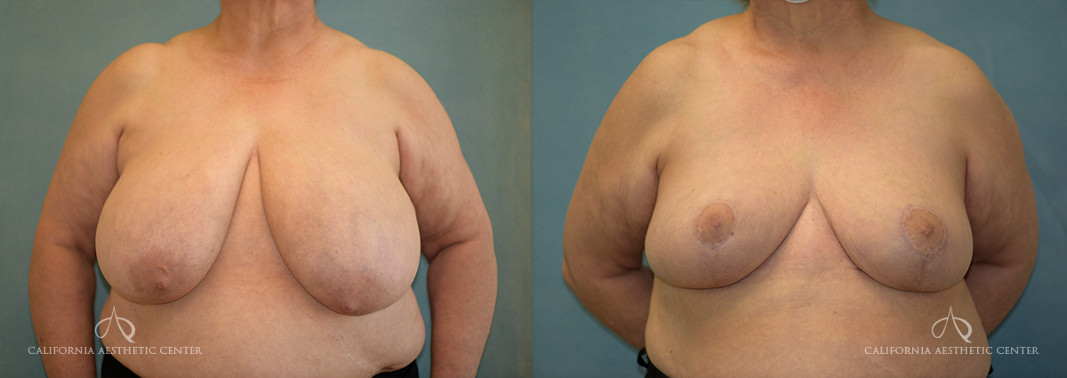 Patient 12 Breast Reduction Front Before and After