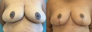 Patient 8 Breast Reduction Before and After Front