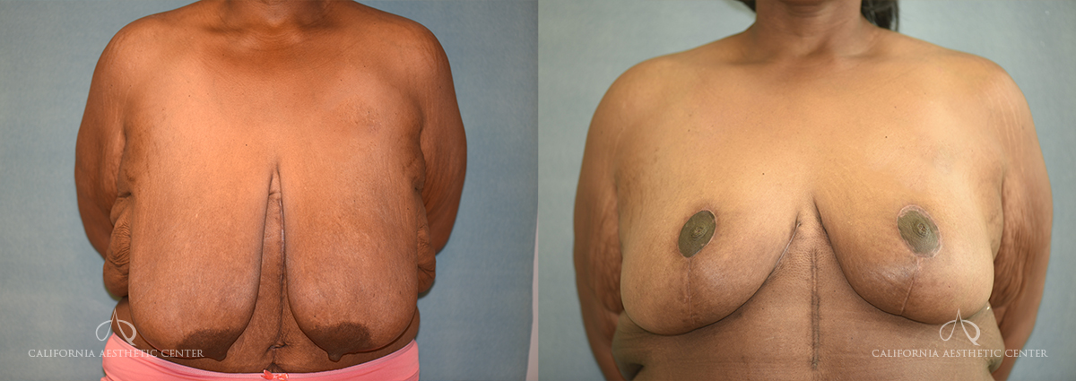 Patient 9 Breast Reduction Front Before and After