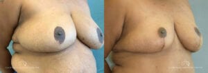 Patient 8 Breast Reduction Before and After Oblique Left