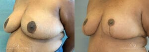 Patient 8 Breast Reduction Before and After Oblique Right
