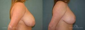 Patient 11 Breast Reduction Side Before and After