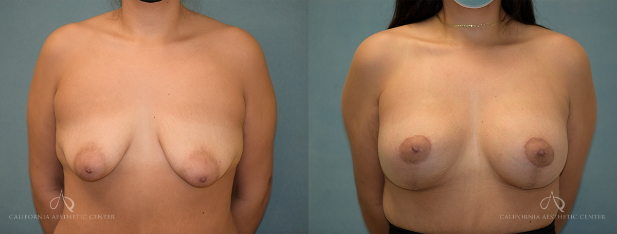 Patient 3 Breast Lift Front Before and After