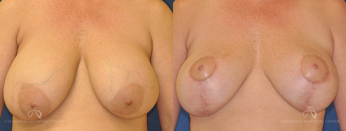 Patient 4 Breast Lift Front Before and After