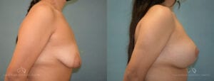 Patient 3 Breast Lift Side Before and After