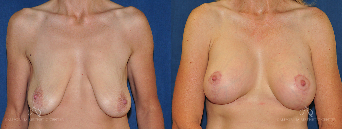 Patient 5 - Breast Lift Side Before and After