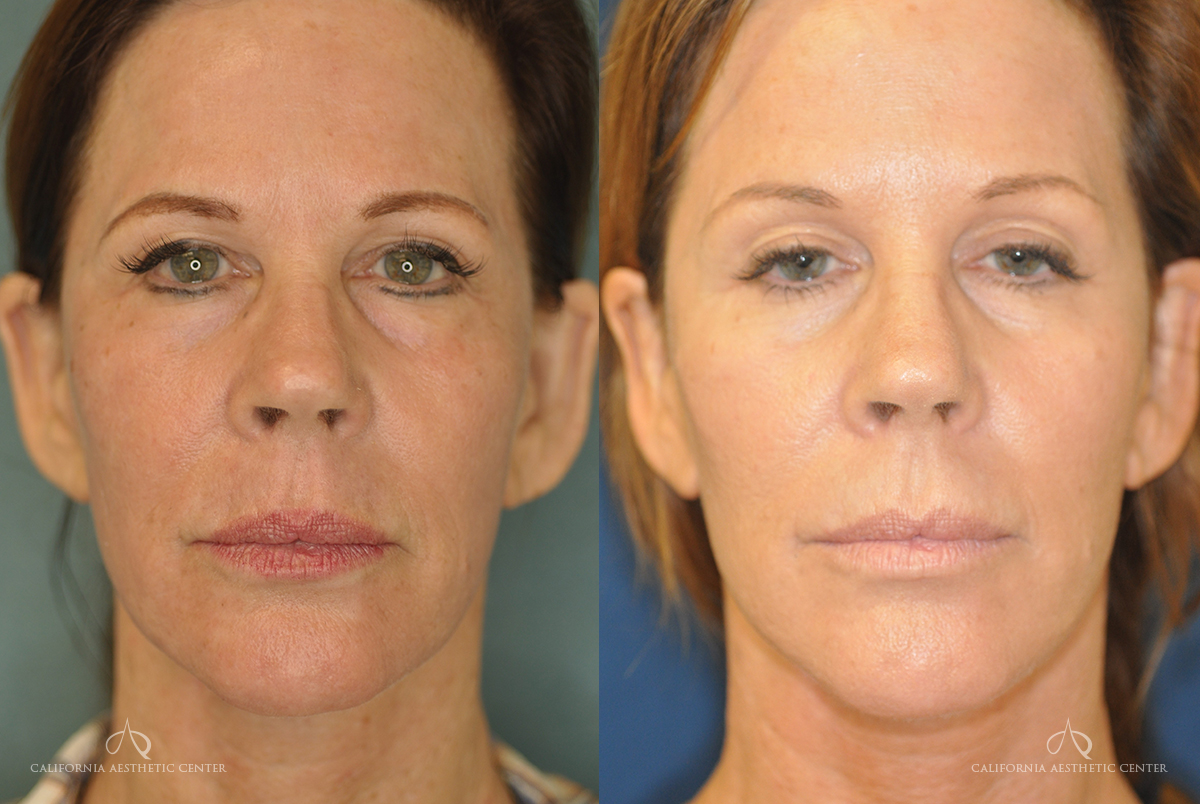 Patient 1 IPL Photofacial Before and After Front