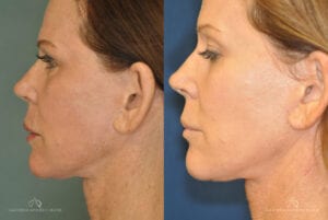 Patient 1 IPL Photofacial Before and After Side