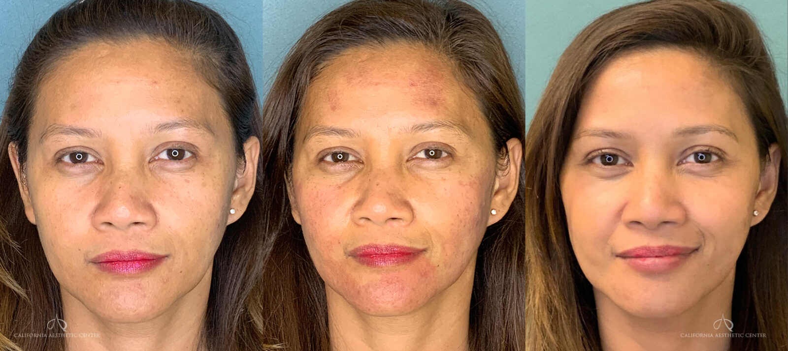 Patient 2 IPL Photofacial Front Before and After