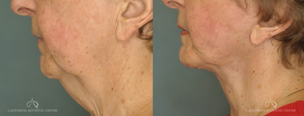 Patient 3 Neck Lift Side Before and After